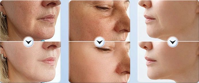 Anti Wrinkle Beauty Apparatus